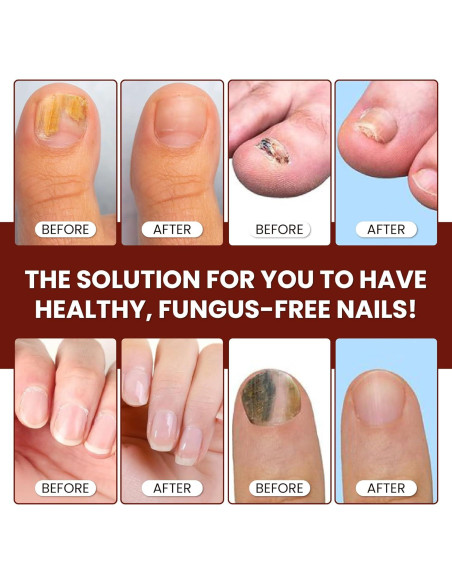 Suero Reparador de Uñas Abera - Cuidado Intensivo Rojo