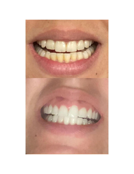 Gel Blanqueador Dental Dr Song 4 Jeringas 35% Peróxido