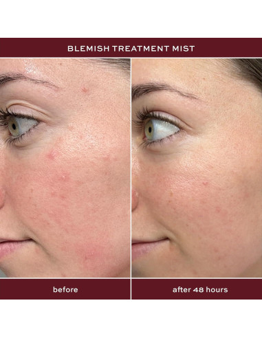 Spray de Ácido Salicílico ITK Skincare 2% para Acné 93.4ml