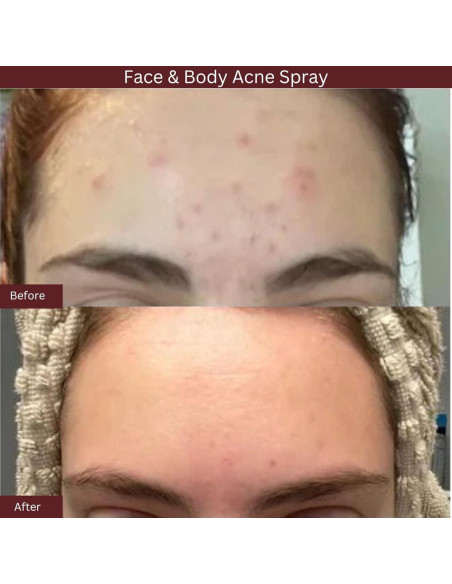 Spray de Ácido Salicílico ITK Skincare 2% para Acné 93.4ml