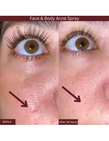 Spray de Ácido Salicílico ITK Skincare 2% para Acné 93.4ml