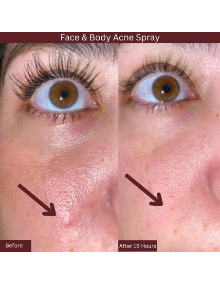 Spray de Ácido Salicílico ITK Skincare 2% para Acné 93.4ml