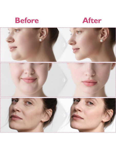 Conjunto Reductor Doble Papada Azrra - Máscara Elevadora V y Ejercitador Mandíbula