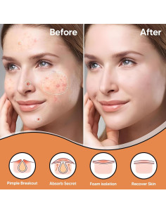 Parche de Acné Hidrocoloide BitMark - 42 Unidades con Espejo 2