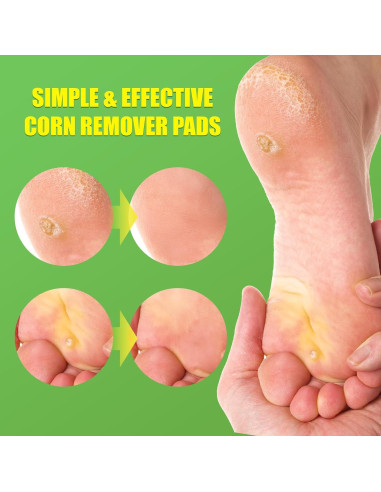 Almohadillas para Callos WABRINY - Eliminación Rápida y Efectiva, 30 Unidades