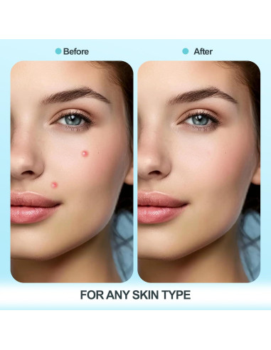 Parche Hidrocoloide para Granos Livaclean 330 Unidades