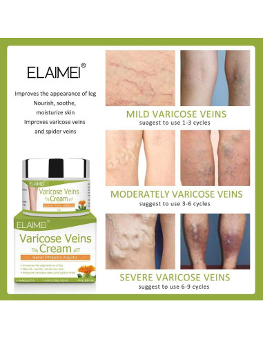 Crema para Venas Varicosas Resdam 2 PCS - Alivio y Reducción