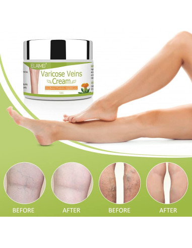 Crema para Venas Varicosas Resdam 2 PCS - Alivio y Reducción