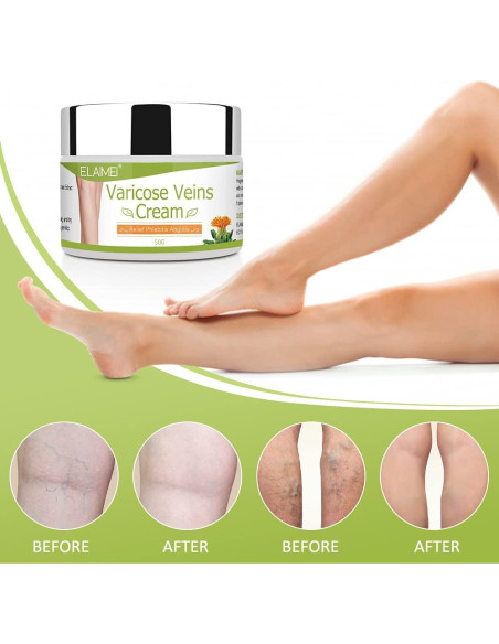 Crema para Venas Varicosas Resdam 2 PCS - Alivio y Reducción