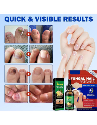 Parche Hidrogel para Uñas Fungosas Jynbloge - 21 Parches + Suero 30ml