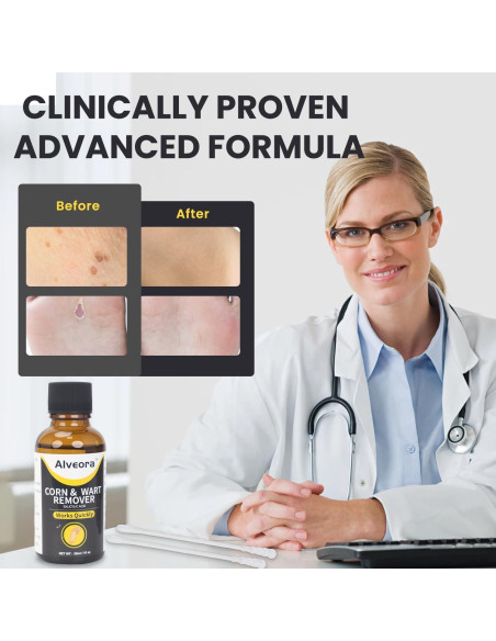 Removedor de Verrugas Líquido Alveora 17% Ácido Salicílico 91g