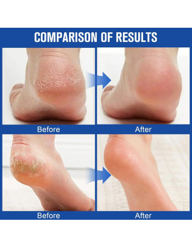 Crema Hidratante 60% Urea Holyarm para Pies y Manos 200g