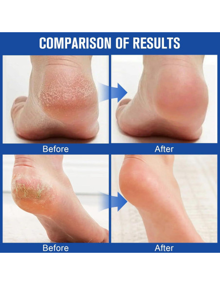 Crema Hidratante 60% Urea Holyarm para Pies y Manos 200g