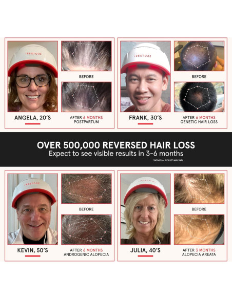 Gorro Láser iRestore Pro para Crecimiento del Cabello