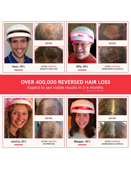 Gorro Láser iRestore - Terapia de Luz Roja para Cabello