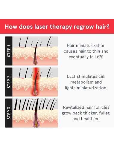 Gorro Láser iRestore - Terapia de Luz Roja para Cabello