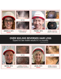 iRestore Pro Gorro Terapia Luz Roja 282 Lásers Crecimiento Cabello 2