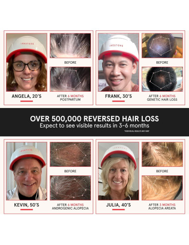 iRestore Pro Gorro Terapia Luz Roja 282 Lásers Crecimiento Cabello