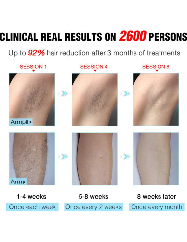 Eliminador de Vello Láser IPL IMENE T2 Indoloro 500,000 Destellos