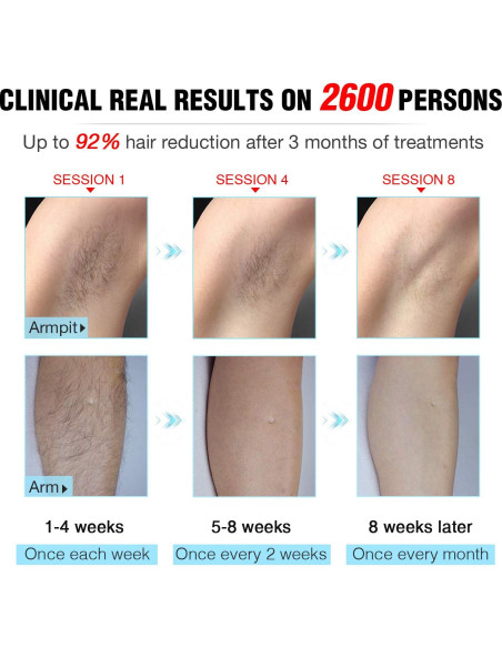 Eliminador de Vello Láser IPL IMENE T2 Indoloro 500,000 Destellos