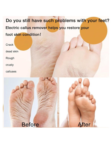 Removedor de Callos Eléctrico Latonyar 2024 USB Recargable
