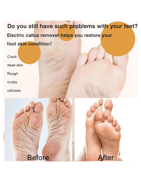 Removedor de Callos Eléctrico Latonyar 2024 USB Recargable