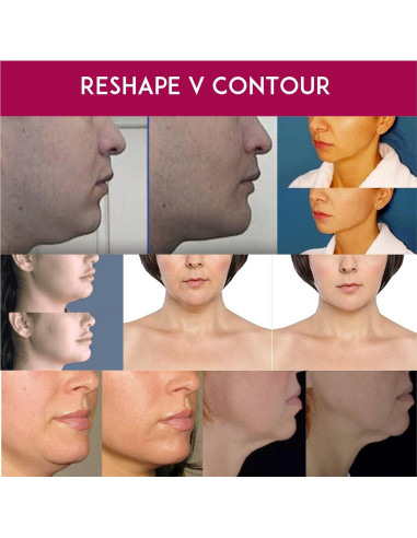 Crema Anti-Envejecimiento para Cuello Anacis 30 ml - Doble Barbilla