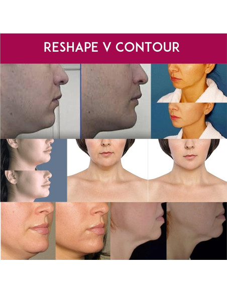 Crema Anti-Envejecimiento para Cuello Anacis 30 ml - Doble Barbilla