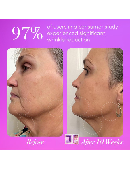 Dispositivo de Terapia de Luz LED reVive dpl IIa para Acné y Arrugas