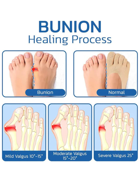 5 Pares de Calcetines Alineadores de Dedos Projoint para Juanetes