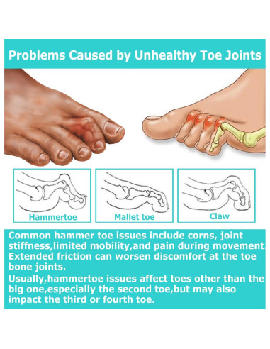 Corrector de Dedo en Garra Byehambuni, 6 Piezas Pequeñas Beige