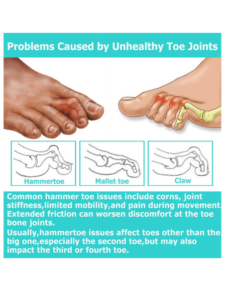 Corrector de Dedo en Garra Byehambuni, 6 Piezas Pequeñas Beige