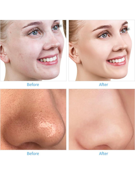 Máquina de Microdermoabrasión Facial mcwdoit - 9 Puntas, USB, Portátil