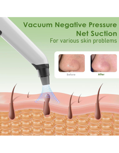Aspiradora de Puntos Negros Xamoca USB 3 Niveles 4 Probes