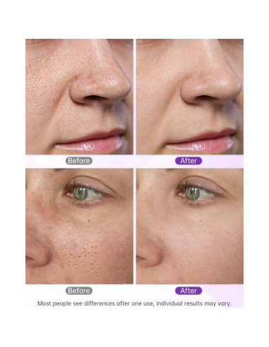 Removedor de Puntos Negros UNOISETION P1-X 2 en 1 Exfoliador