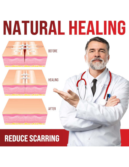 Tiras de Cierre de Heridas MyHelp - 2 Pack - Vendajes en Mariposa