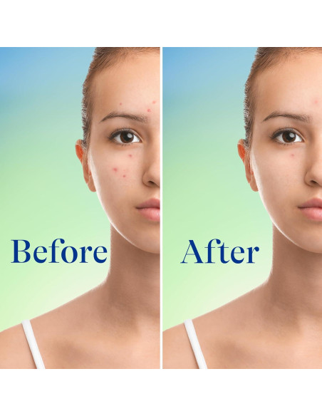 Limpiador Facial Differin 148 ml - 10% Peróxido de Benzoilo