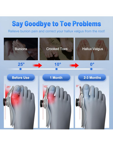 Corrector de Juanetes Qlonn Ajustable para Alivio de Dolor