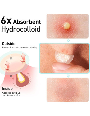 Parche para Acné TKTK 12mm Hidrocoloide 48 Unidades