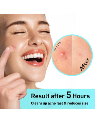 Parche para Acné TKTK 12mm Hidrocoloide 48 Unidades