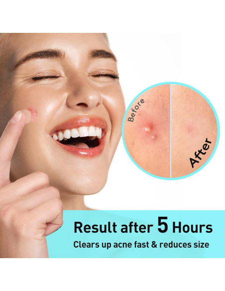 Parche para Acné TKTK 12mm Hidrocoloide 48 Unidades Parche para Acné TKTK 12mm Hidrocoloide 48 Unidades