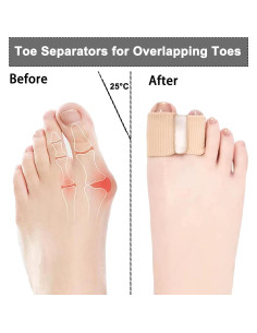 Separadores de Dedos para Juanetes Whycalon 4 Piezas Gel 2