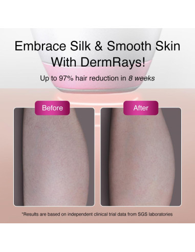 Depilación Láser Diodo DermRays 1064nm para Piel Oscura