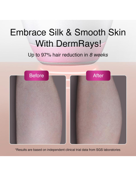 Depilación Láser Diodo DermRays 1064nm para Piel Oscura