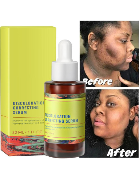 Suero Corrector de Manchas Oscuras NAILKISS 30ml