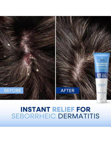 Crema Antipicazón Hermon para Dermatitis Seborreica 81.9g