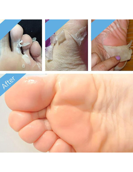 Máscara Exfoliante para Pies BEALUZ - 2 Pares, Suaves en 1-2 Semanas