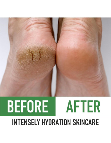 Crema para Pies 40% Urea PurSources - Hidratante y Removedor de Callos