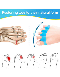 Separadores de Dedos Juzure 8 PCS Silicona Correctores Juanetes 2