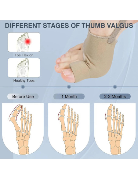 Corrector de Juanetes GLASSMARC 2PCS Alivio Dolor Transpirable